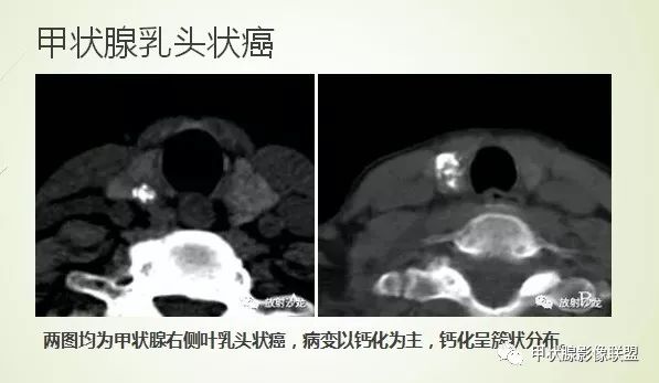 影像PPT - 甲状腺结节次要征象解读-16 影像PPT - 甲状腺结节次要征象解读-16