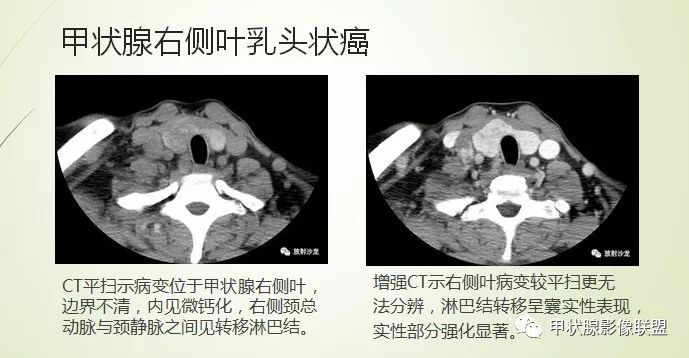 影像PPT - 甲状腺结节次要征象解读-17 影像PPT - 甲状腺结节次要征象解读-17