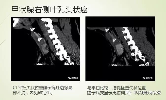 影像PPT - 甲状腺结节次要征象解读-18 影像PPT - 甲状腺结节次要征象解读-18