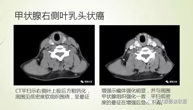 影像PPT - 甲状腺结节次要征象解读-20 影像PPT - 甲状腺结节次要征象解读-20