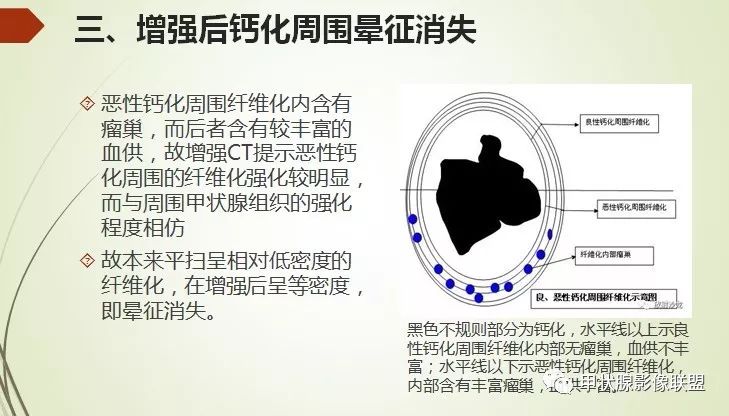 影像PPT - 甲状腺结节次要征象解读-19 影像PPT - 甲状腺结节次要征象解读-19
