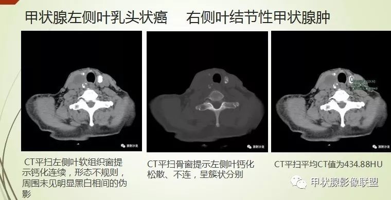 影像PPT - 甲状腺结节次要征象解读-21 影像PPT - 甲状腺结节次要征象解读-21