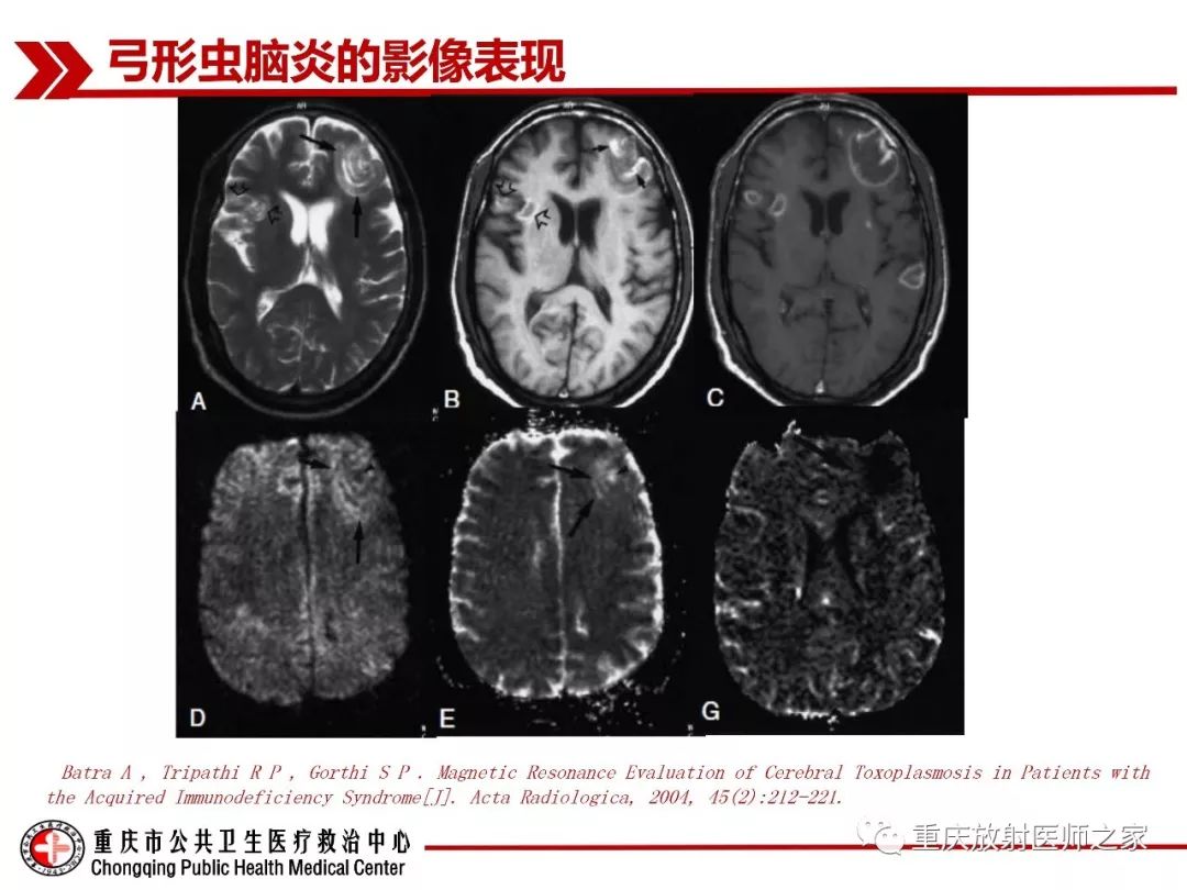 影像PPT - 【PPT】艾滋病相关弓形虫脑炎的影像表现-9