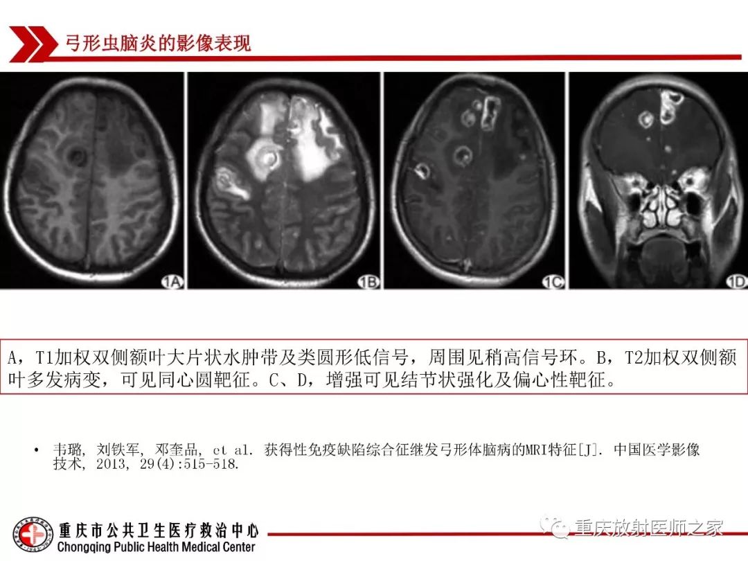 影像PPT - 【PPT】艾滋病相关弓形虫脑炎的影像表现-12