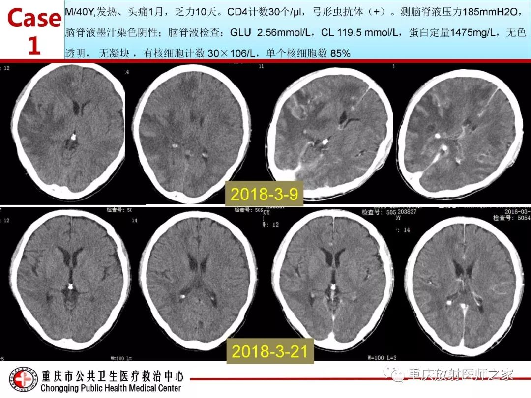 影像PPT - 【PPT】艾滋病相关弓形虫脑炎的影像表现-16