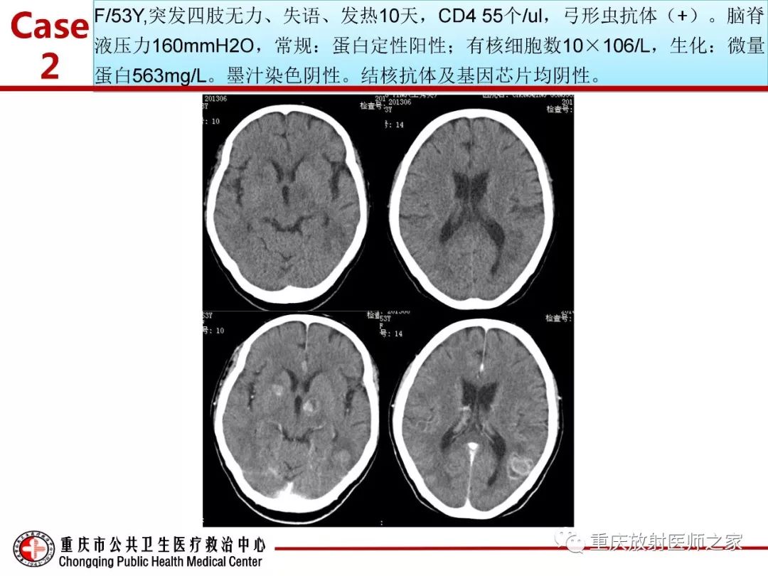 影像PPT - 【PPT】艾滋病相关弓形虫脑炎的影像表现-17
