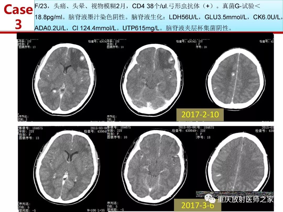 影像PPT - 【PPT】艾滋病相关弓形虫脑炎的影像表现-18
