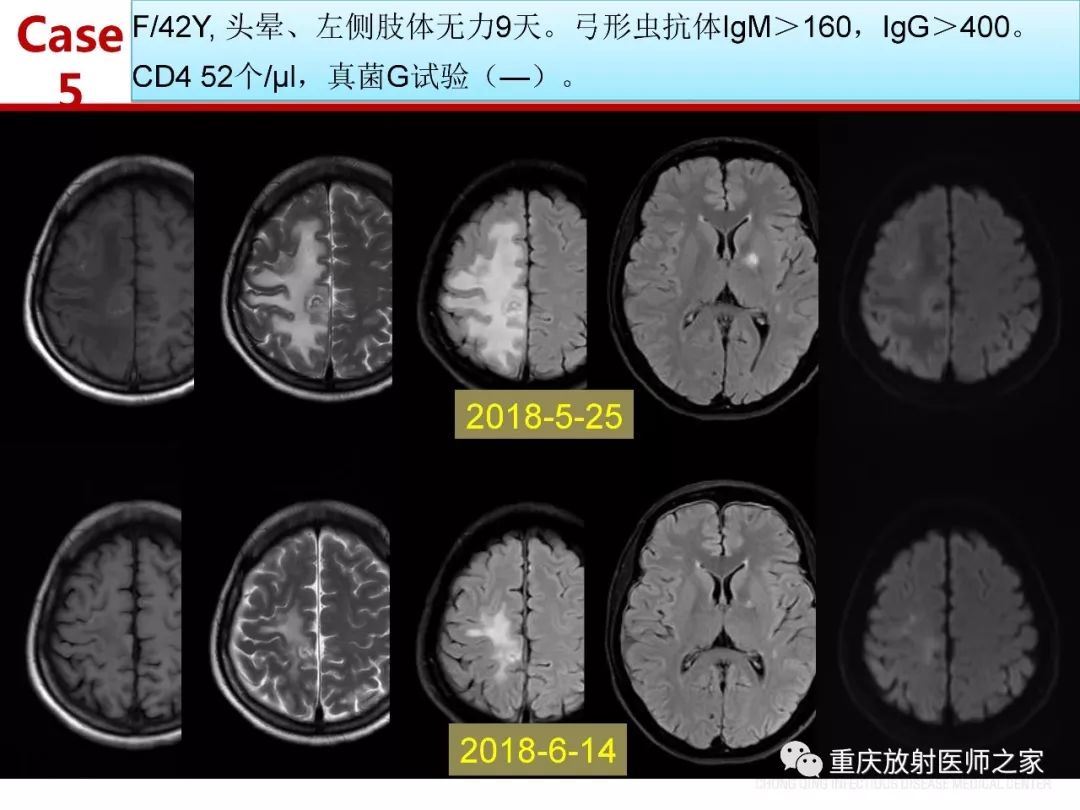 影像PPT - 【PPT】艾滋病相关弓形虫脑炎的影像表现-20