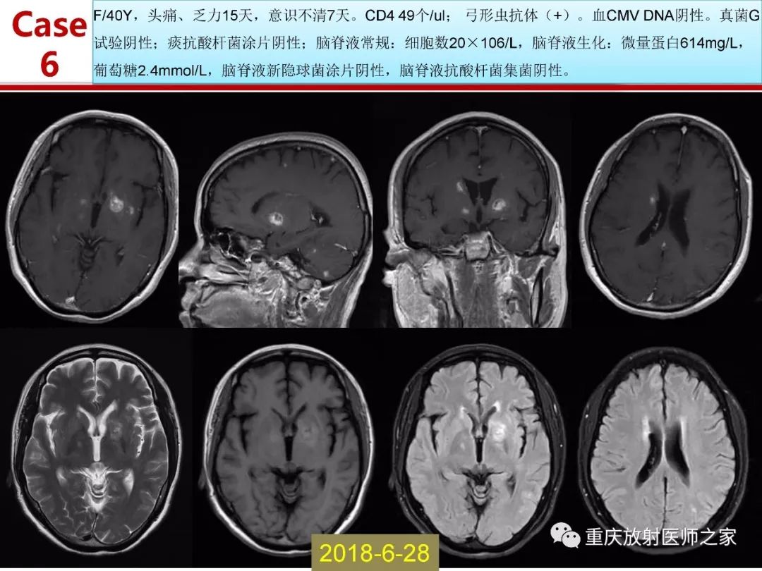 影像PPT - 【PPT】艾滋病相关弓形虫脑炎的影像表现-21