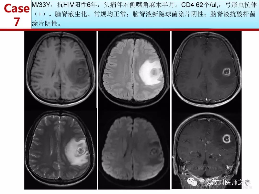 影像PPT - 【PPT】艾滋病相关弓形虫脑炎的影像表现-22
