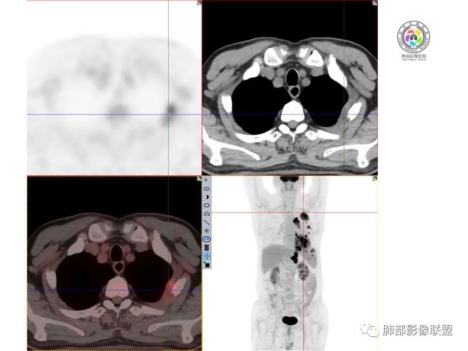 影像PPT - 【病例】恶性胸膜间皮瘤1例CT-7 影像PPT - 【病例】恶性胸膜间皮瘤1例CT-7