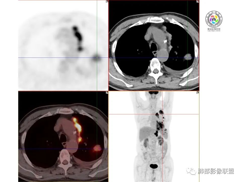 影像PPT - 【病例】恶性胸膜间皮瘤1例CT-10 影像PPT - 【病例】恶性胸膜间皮瘤1例CT-10