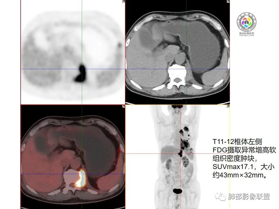影像PPT - 【病例】恶性胸膜间皮瘤1例CT-12 影像PPT - 【病例】恶性胸膜间皮瘤1例CT-12