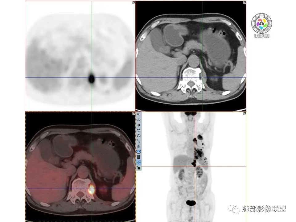 影像PPT - 【病例】恶性胸膜间皮瘤1例CT-14 影像PPT - 【病例】恶性胸膜间皮瘤1例CT-14