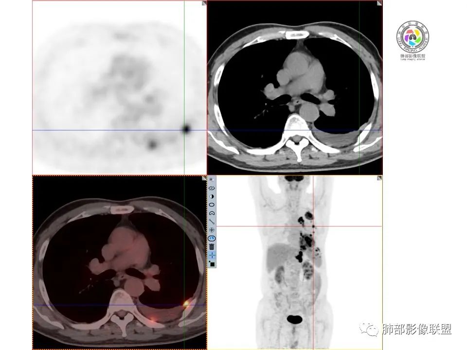 影像PPT - 【病例】恶性胸膜间皮瘤1例CT-16 影像PPT - 【病例】恶性胸膜间皮瘤1例CT-16