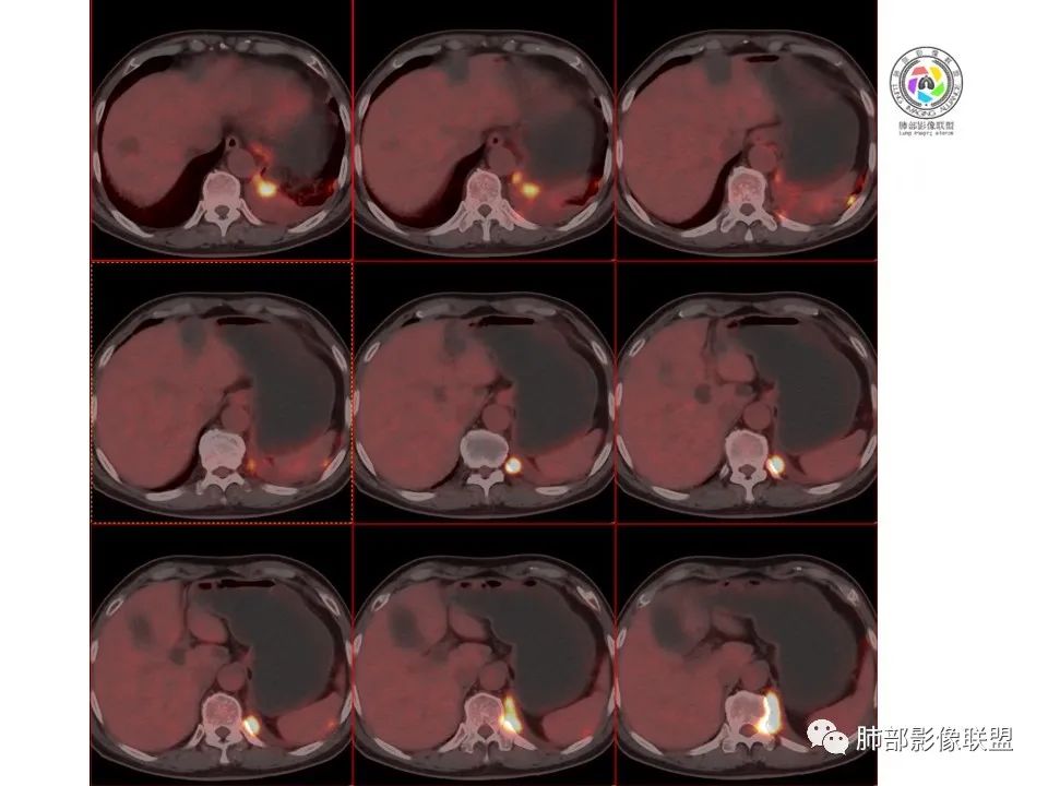 影像PPT - 【病例】恶性胸膜间皮瘤1例CT-26 影像PPT - 【病例】恶性胸膜间皮瘤1例CT-26