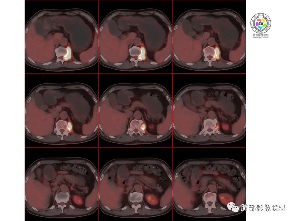 影像PPT - 【病例】恶性胸膜间皮瘤1例CT-27 影像PPT - 【病例】恶性胸膜间皮瘤1例CT-27