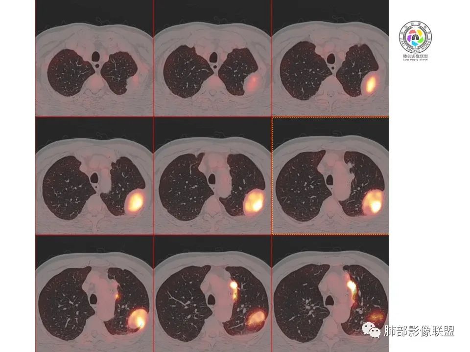 影像PPT - 【病例】恶性胸膜间皮瘤1例CT-28 影像PPT - 【病例】恶性胸膜间皮瘤1例CT-28
