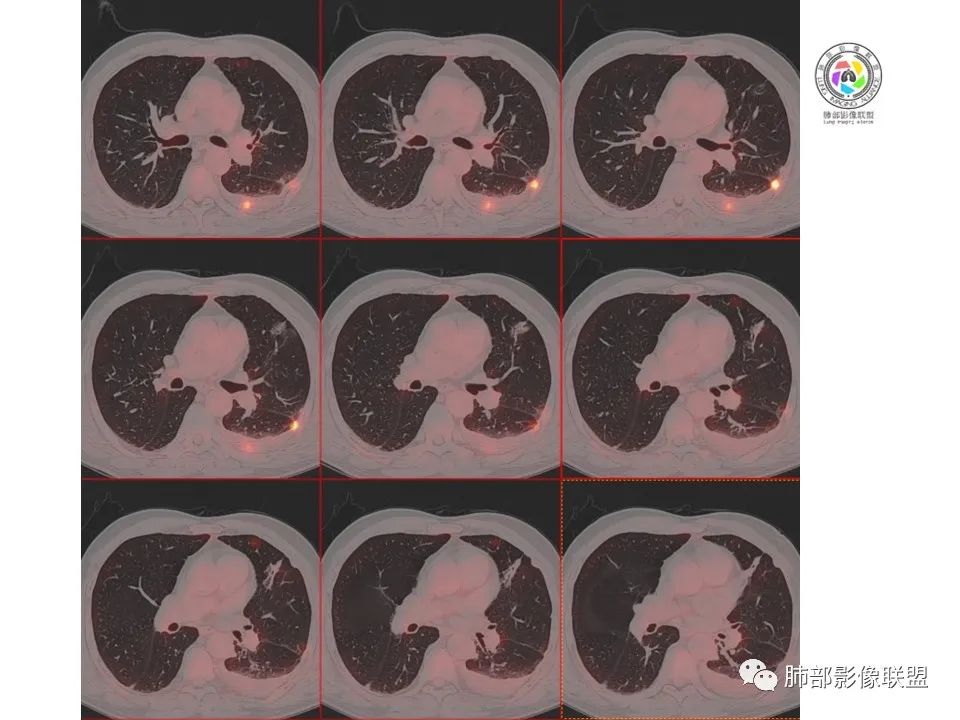影像PPT - 【病例】恶性胸膜间皮瘤1例CT-30 影像PPT - 【病例】恶性胸膜间皮瘤1例CT-30