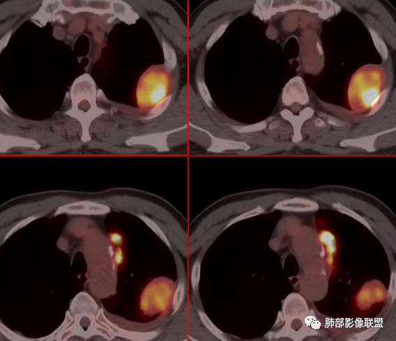 影像PPT - 【病例】恶性胸膜间皮瘤1例CT-41 影像PPT - 【病例】恶性胸膜间皮瘤1例CT-41