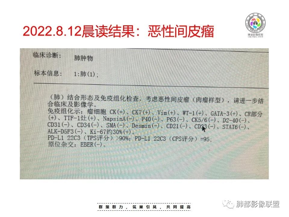 影像PPT - 【病例】恶性胸膜间皮瘤1例CT-42 影像PPT - 【病例】恶性胸膜间皮瘤1例CT-42