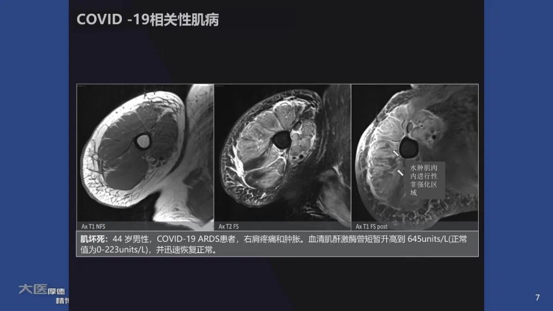 影像PPT - 【PPT】COVID-19 的肌肉骨骼表现：对目前所描述的多模态成像及临床症状的图片综述​-5