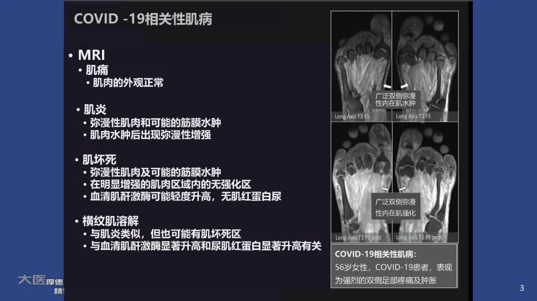 影像PPT - 【PPT】COVID-19 的肌肉骨骼表现：对目前所描述的多模态成像及临床症状的图片综述​-1