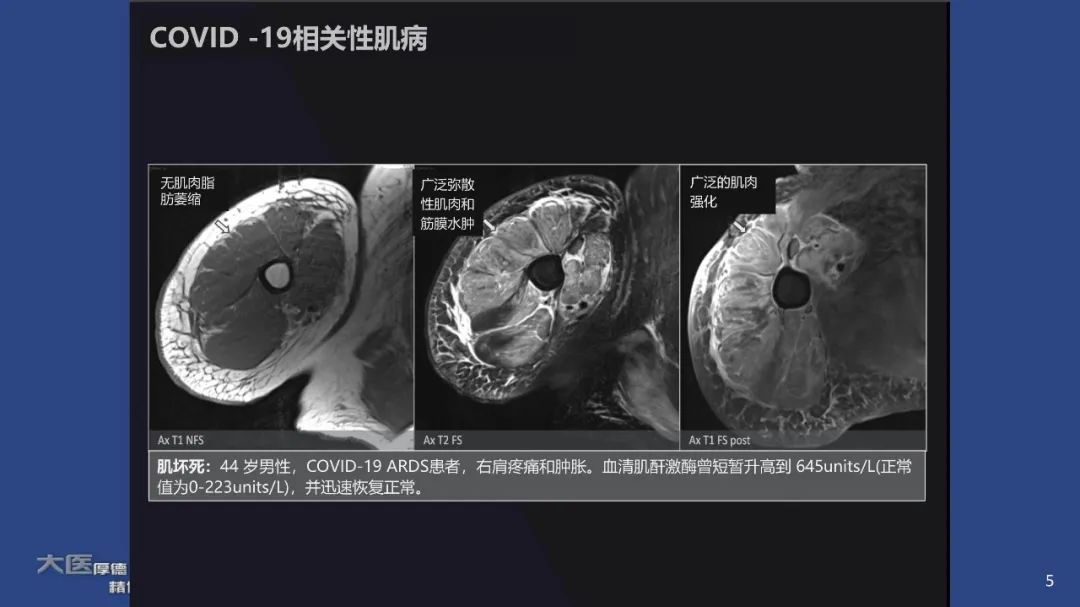 影像PPT - 【PPT】COVID-19 的肌肉骨骼表现：对目前所描述的多模态成像及临床症状的图片综述​-3