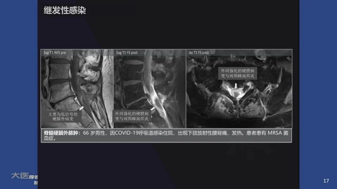 影像PPT - 【PPT】COVID-19 的肌肉骨骼表现：对目前所描述的多模态成像及临床症状的图片综述​-15
