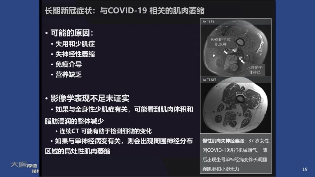 影像PPT - 【PPT】COVID-19 的肌肉骨骼表现：对目前所描述的多模态成像及临床症状的图片综述​-17