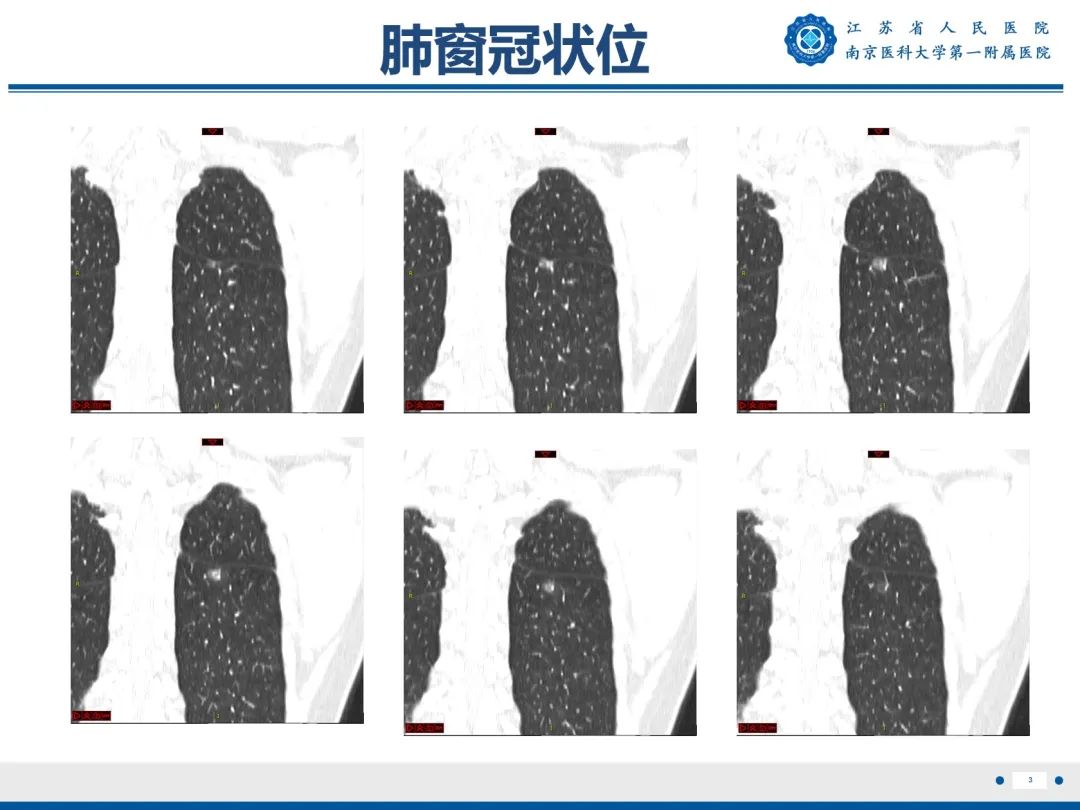 影像PPT - 【PPT】肺微浸润性腺癌-4