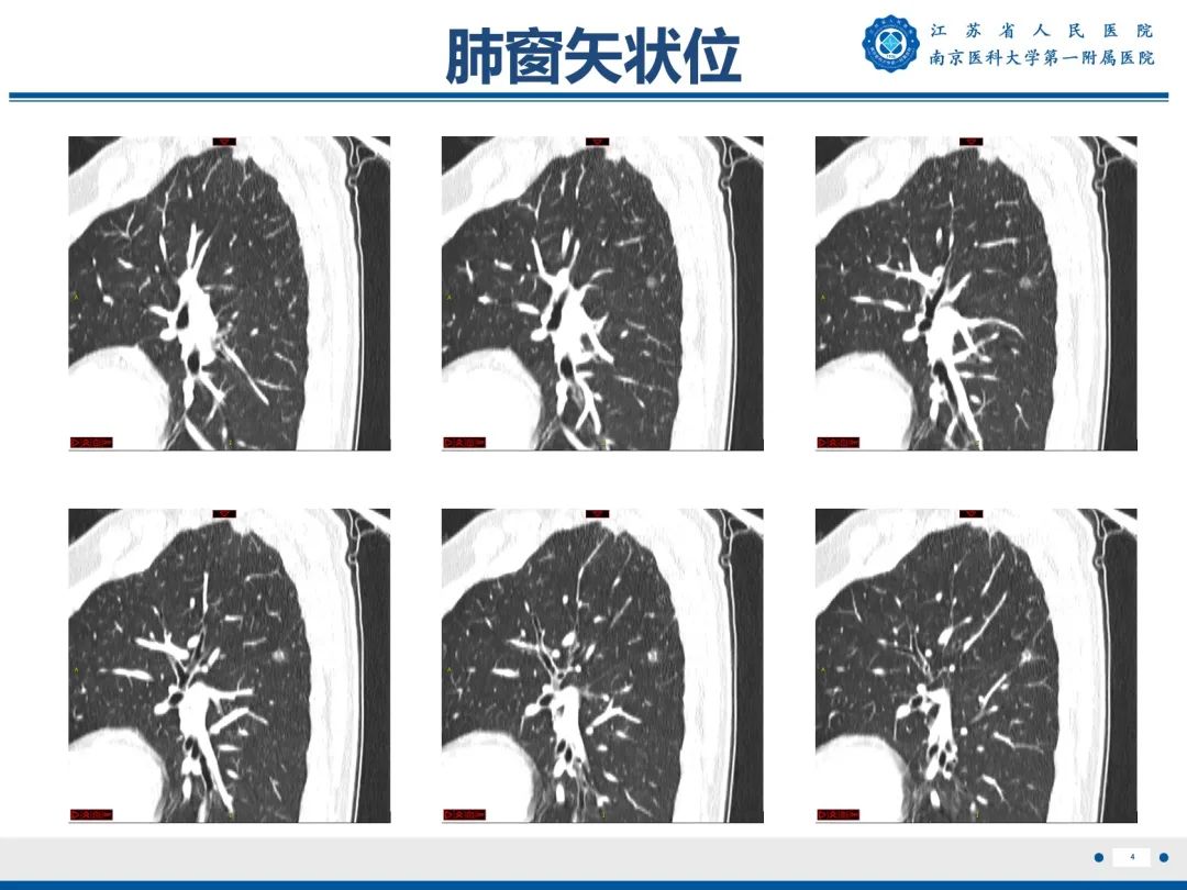 影像PPT - 【PPT】肺微浸润性腺癌-5