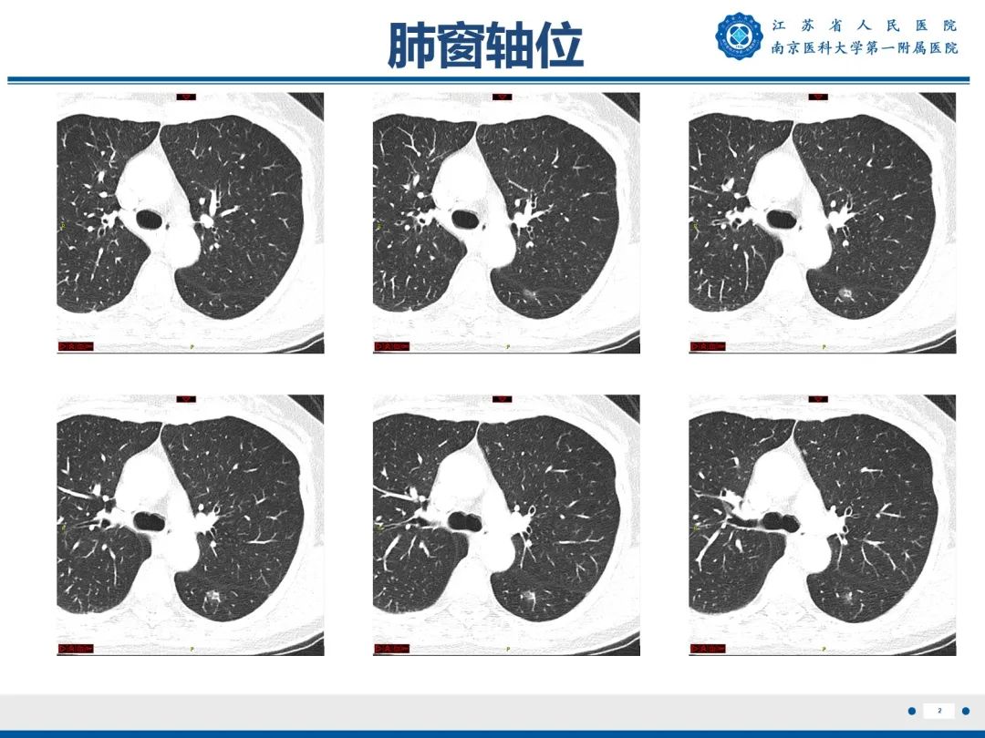影像PPT - 【PPT】肺微浸润性腺癌-3