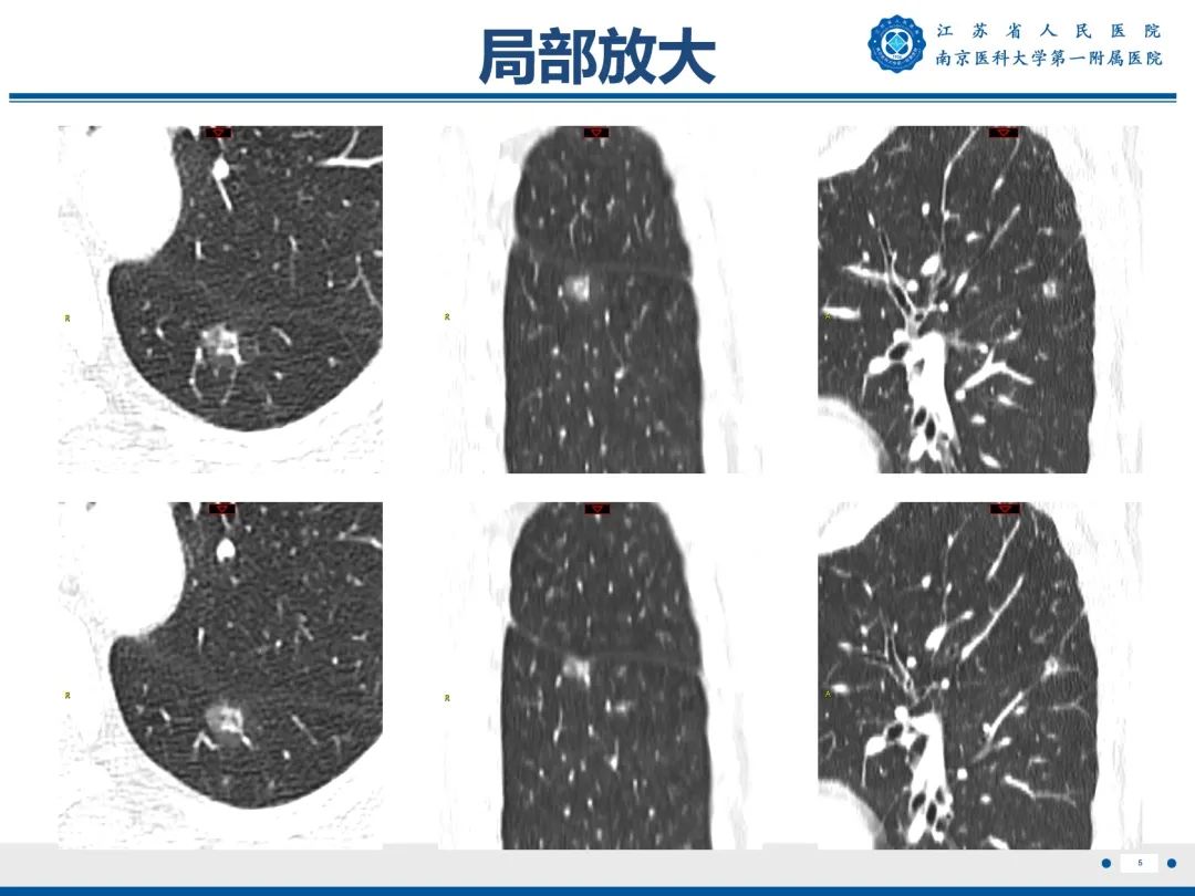 影像PPT - 【PPT】肺微浸润性腺癌-6