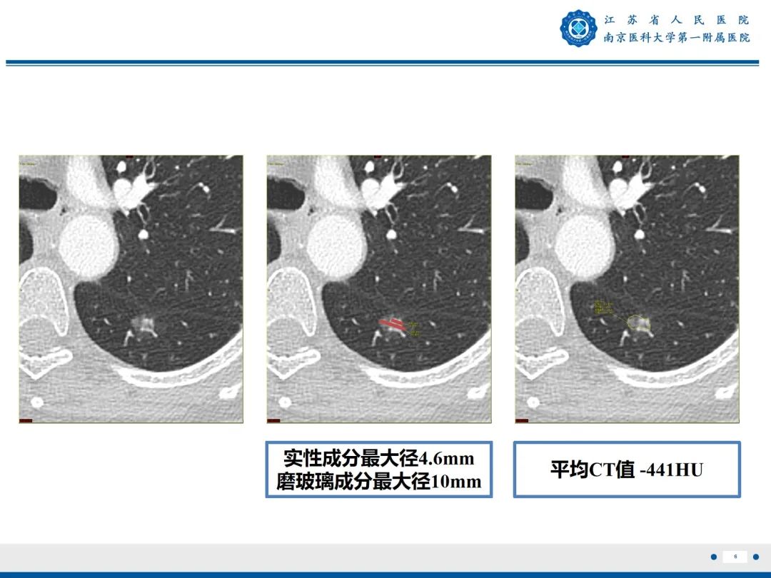 影像PPT - 【PPT】肺微浸润性腺癌-7