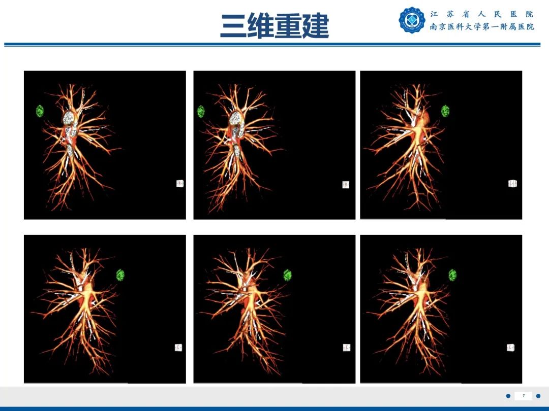 影像PPT - 【PPT】肺微浸润性腺癌-8
