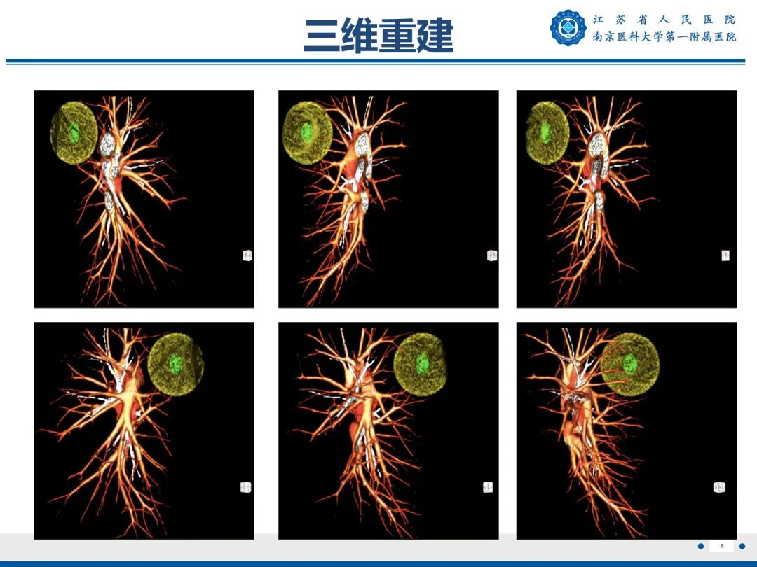 影像PPT - 【PPT】肺微浸润性腺癌-9