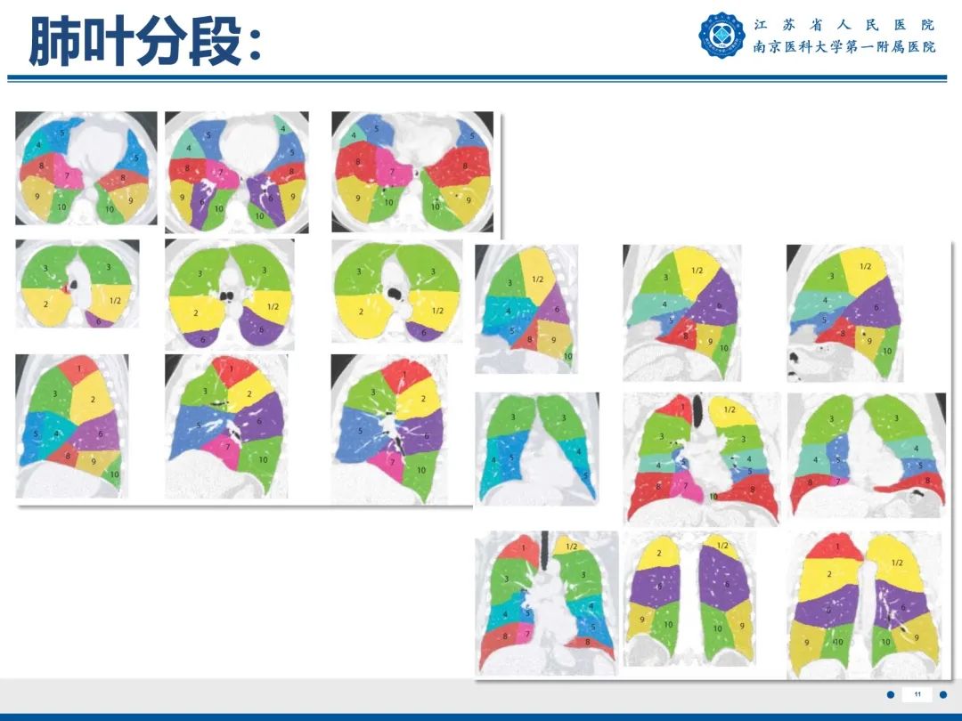 影像PPT - 【PPT】肺微浸润性腺癌-12