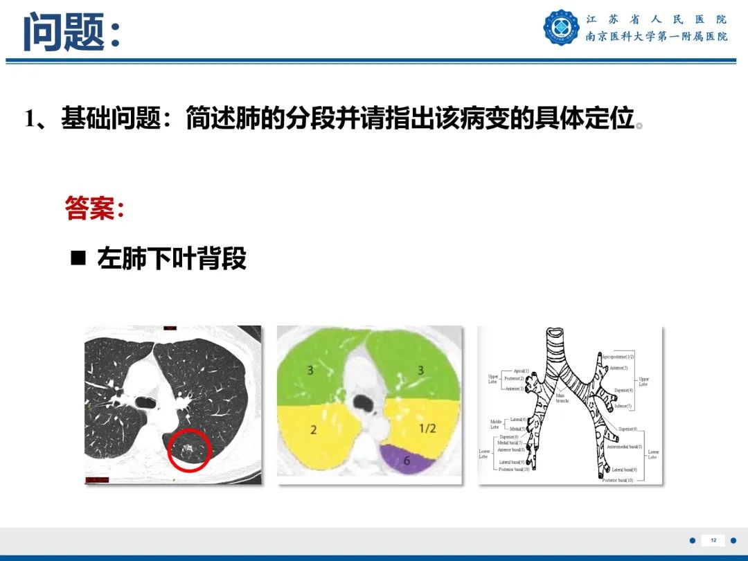 影像PPT - 【PPT】肺微浸润性腺癌-13