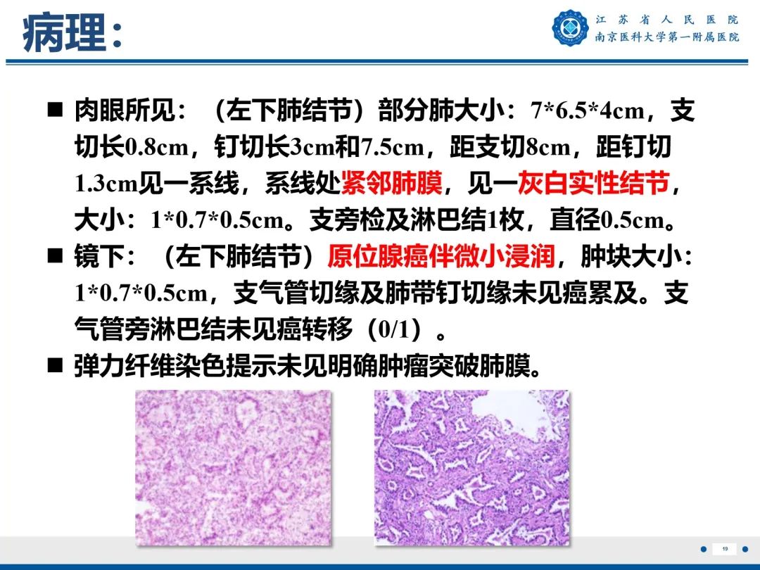 影像PPT - 【PPT】肺微浸润性腺癌-20