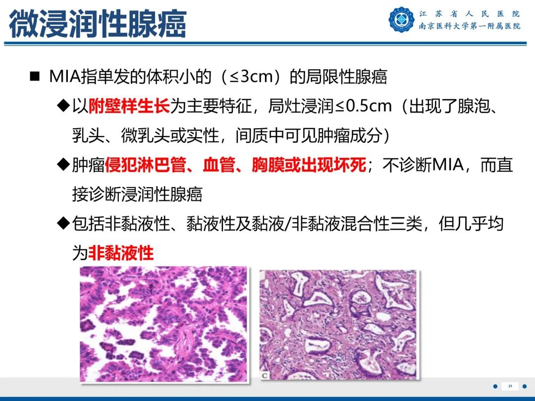 影像PPT - 【PPT】肺微浸润性腺癌-22
