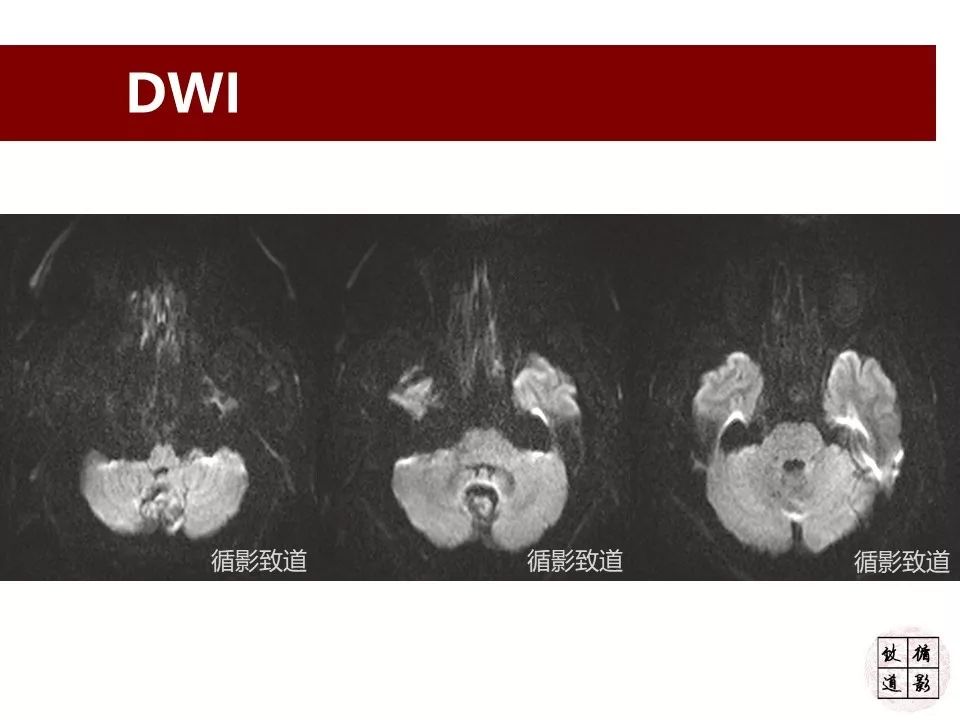 影像PPT - 【病例】小脑高级别胶质瘤1例MR-6 影像PPT - 【病例】小脑高级别胶质瘤1例MR-6