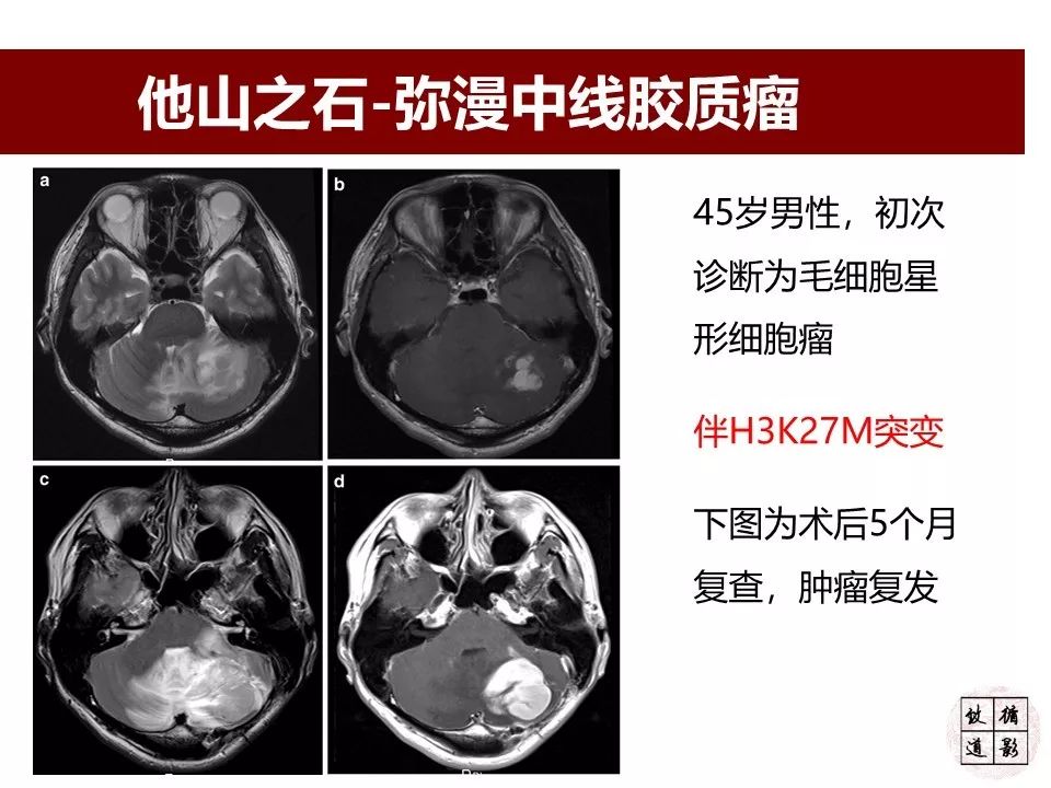 影像PPT - 【病例】小脑高级别胶质瘤1例MR-16 影像PPT - 【病例】小脑高级别胶质瘤1例MR-16