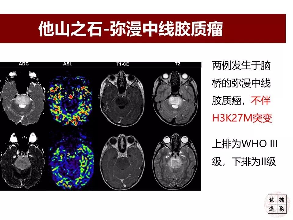影像PPT - 【病例】小脑高级别胶质瘤1例MR-17 影像PPT - 【病例】小脑高级别胶质瘤1例MR-17
