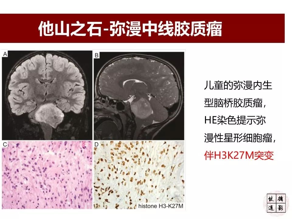 影像PPT - 【病例】小脑高级别胶质瘤1例MR-15 影像PPT - 【病例】小脑高级别胶质瘤1例MR-15
