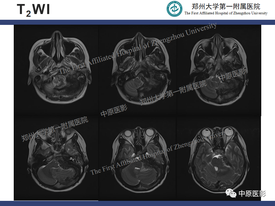影像PPT - 【病例】桥小脑角区脑膜瘤1例MR-4