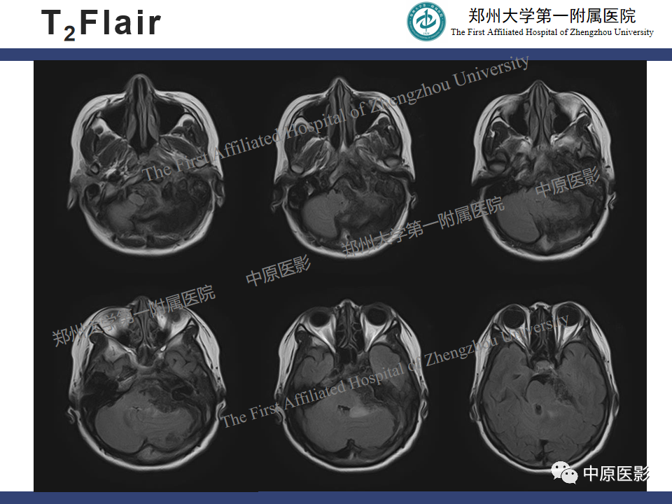 影像PPT - 【病例】桥小脑角区脑膜瘤1例MR-5