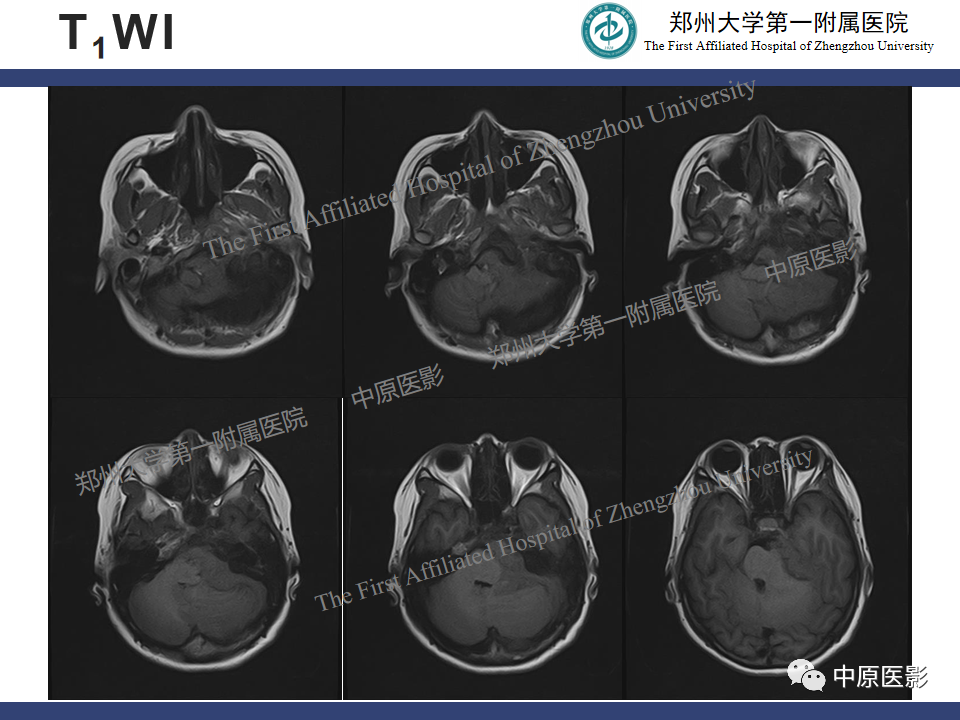 影像PPT - 【病例】桥小脑角区脑膜瘤1例MR-3