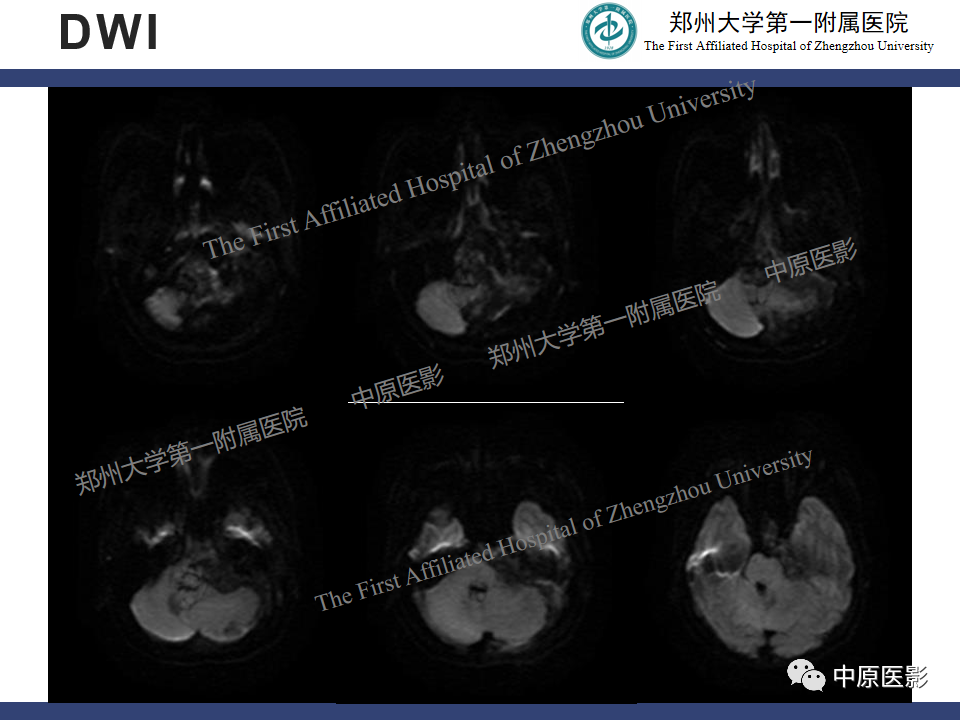 影像PPT - 【病例】桥小脑角区脑膜瘤1例MR-6