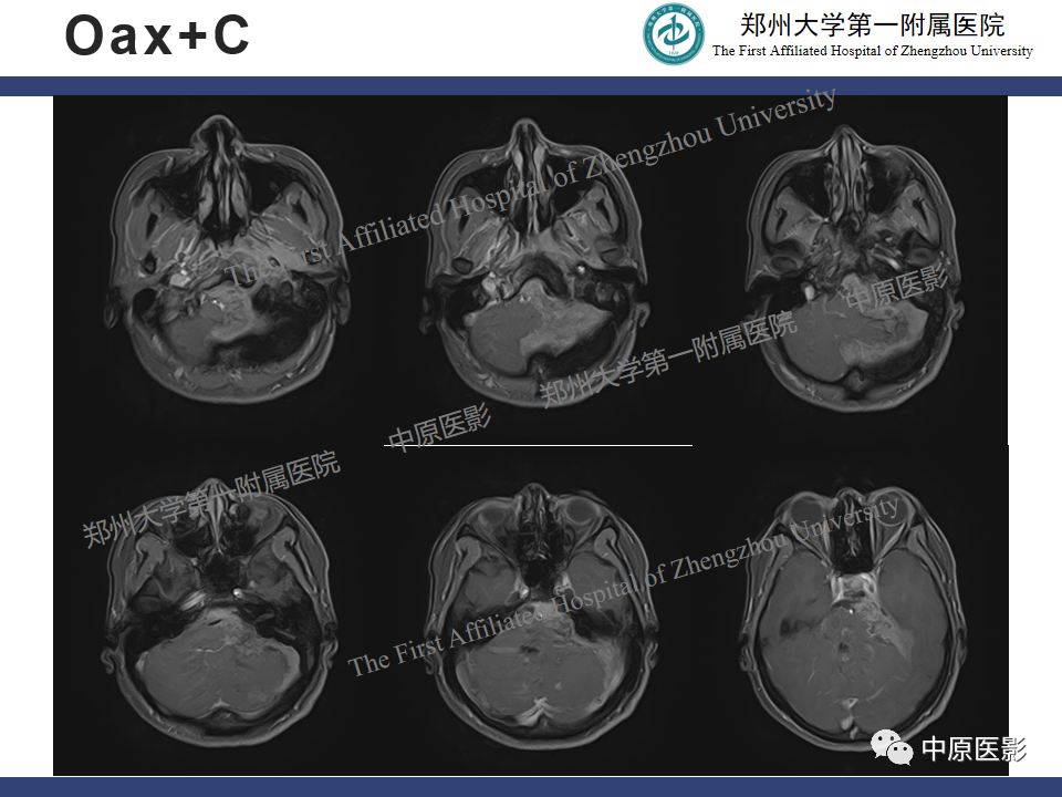 影像PPT - 【病例】桥小脑角区脑膜瘤1例MR-7